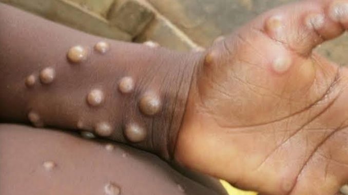RDC : La recrudescence de l’épidémie de variole de singe, la situation devient alarmante